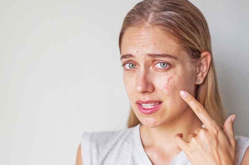 Come liberarsi dell’acne in modo naturale